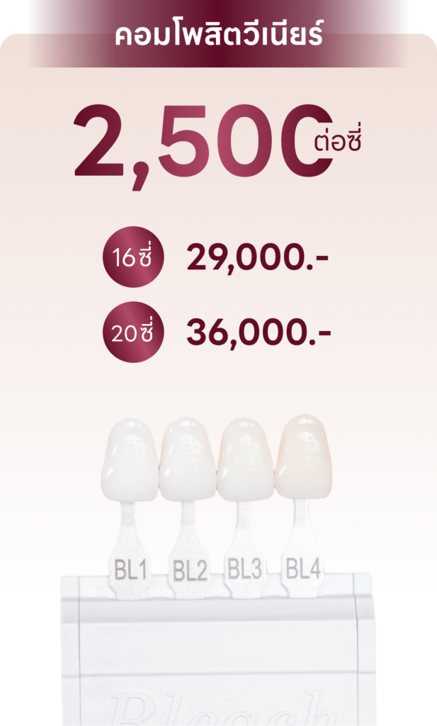 ราคา วีเนียร์ คอมโพสิต