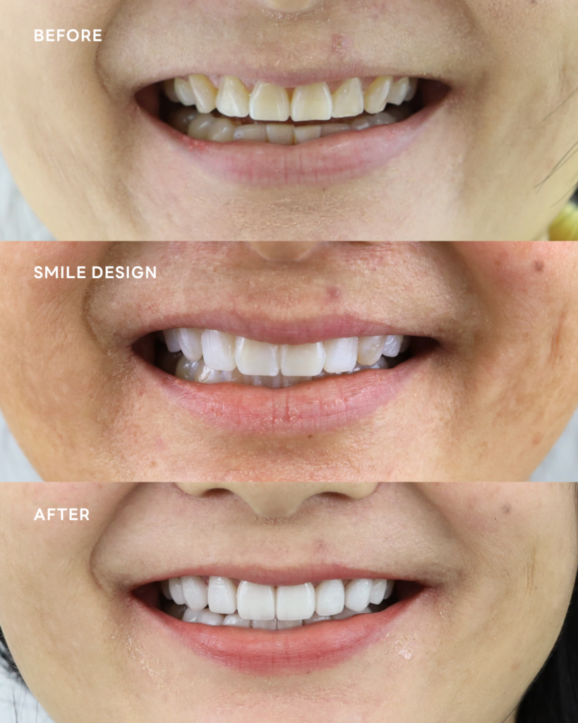 รีวิวการทำ วีเนียร์ yes tooth