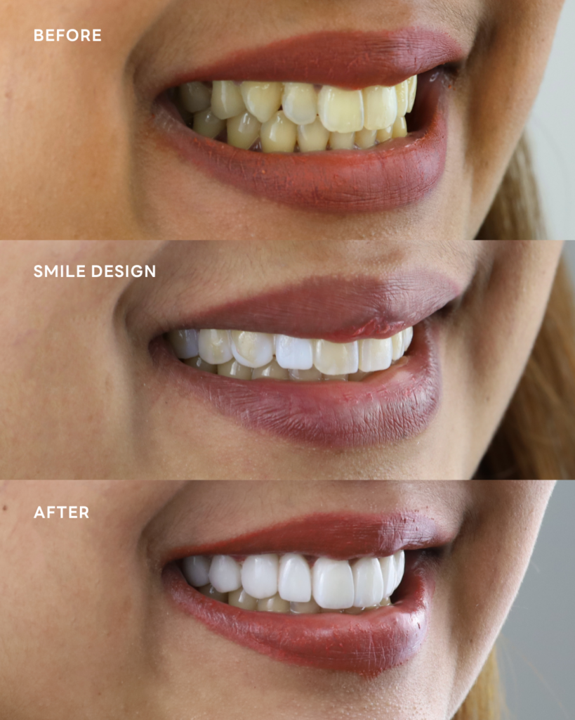 รีวิวการทำ วีเนียร์ yes tooth