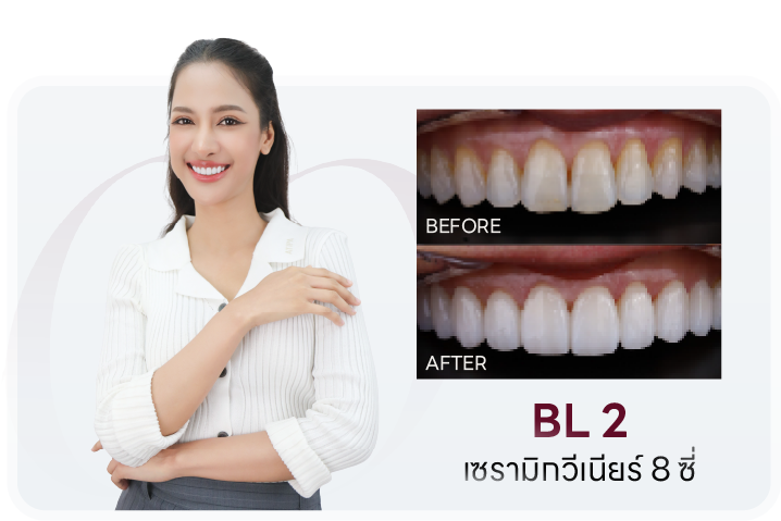 เคสเซรามิกวีเนียร์ 8 ซี่ เฉดสี BL2 เปรียบเทียบก่อน-หลัง