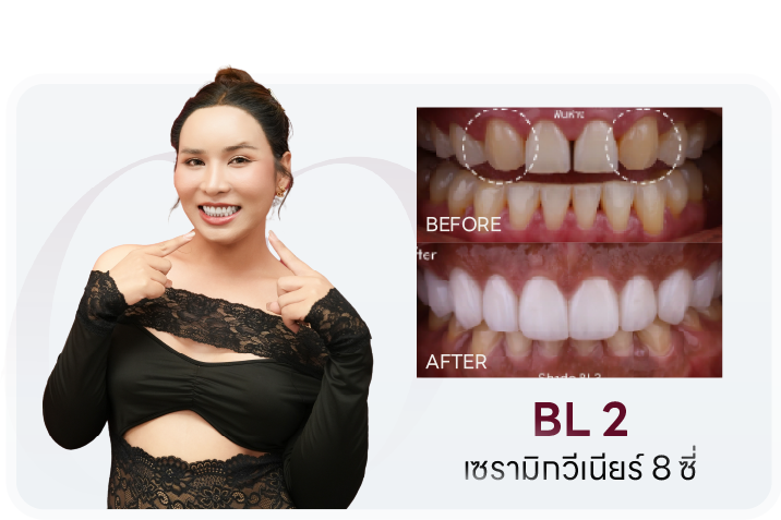เคสเซรามิกวีเนียร์ 8 ซี่ เฉดสี BL2 เปรียบเทียบก่อน-หลัง