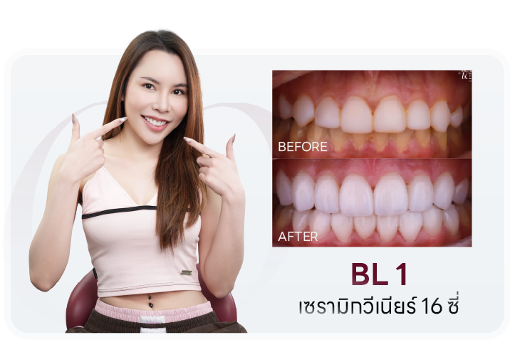 เคสเซรามิกวีเนียร์ 16 ซี่ เฉดสี BL1 เปรียบเทียบก่อน-หลัง