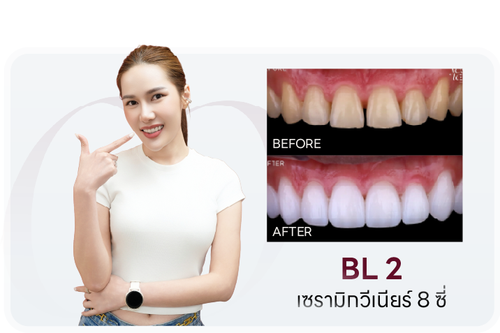 เคสเซรามิกวีเนียร์ 8 ซี่ เฉดสี BL2 เปรียบเทียบก่อน-หลัง