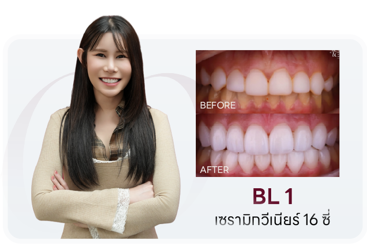 เคสเซรามิกวีเนียร์ 16 ซี่ เฉดสี BL1 เปรียบเทียบก่อน-หลัง