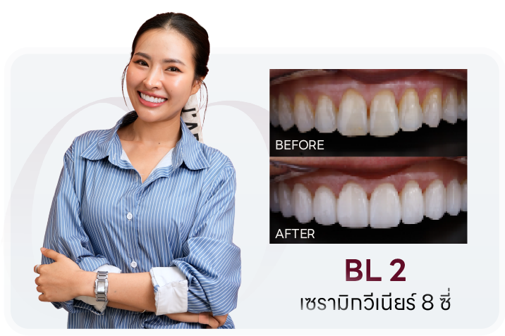 เคสเซรามิกวีเนียร์ 8 ซี่ เฉดสี BL2 เปรียบเทียบก่อน-หลัง